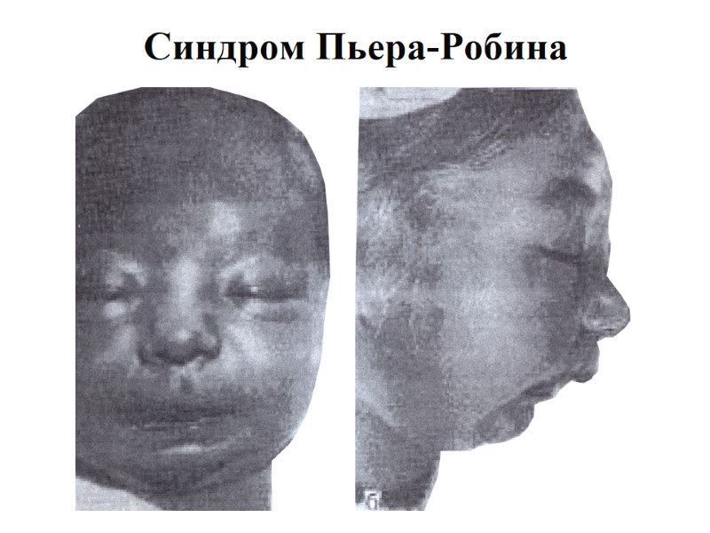 Синдром Пьера-Робина